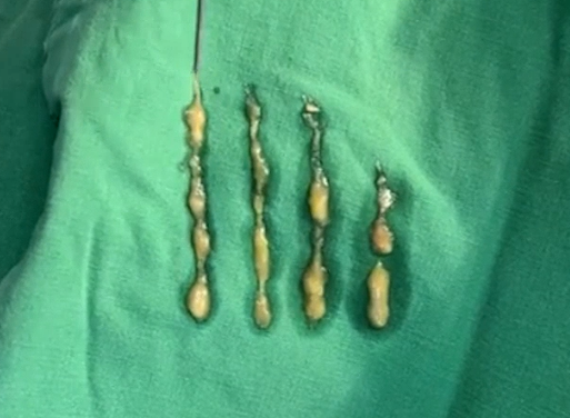 What Is the Secret to Keeping Under-Eye Fat Grafting Beautiful and Natural for a Long Time? image 2