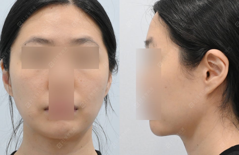 Is simple liposuction enough for double chin surgery? image 6
