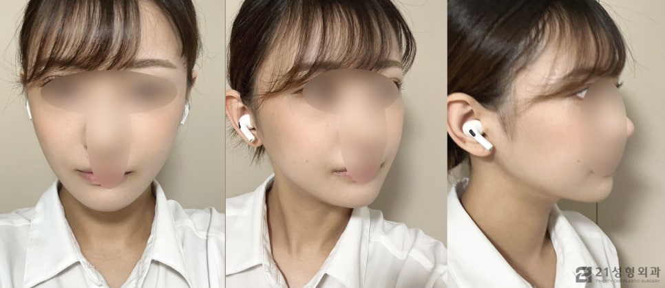 옆광대수술 세련된 이미지로 아름답게 관련 이미지 5