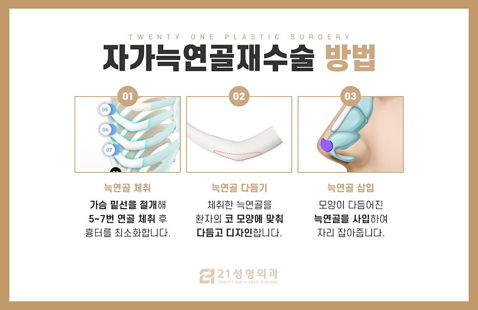 자가늑연골재수술 만족도를 높이는 포인트 관련 이미지 6
