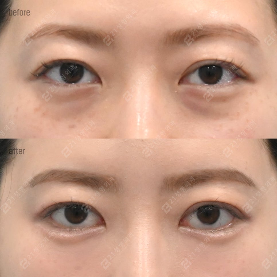 애교와 눈밑지방재배치는 왜 함께 고려해야 할까? 관련 이미지 1
