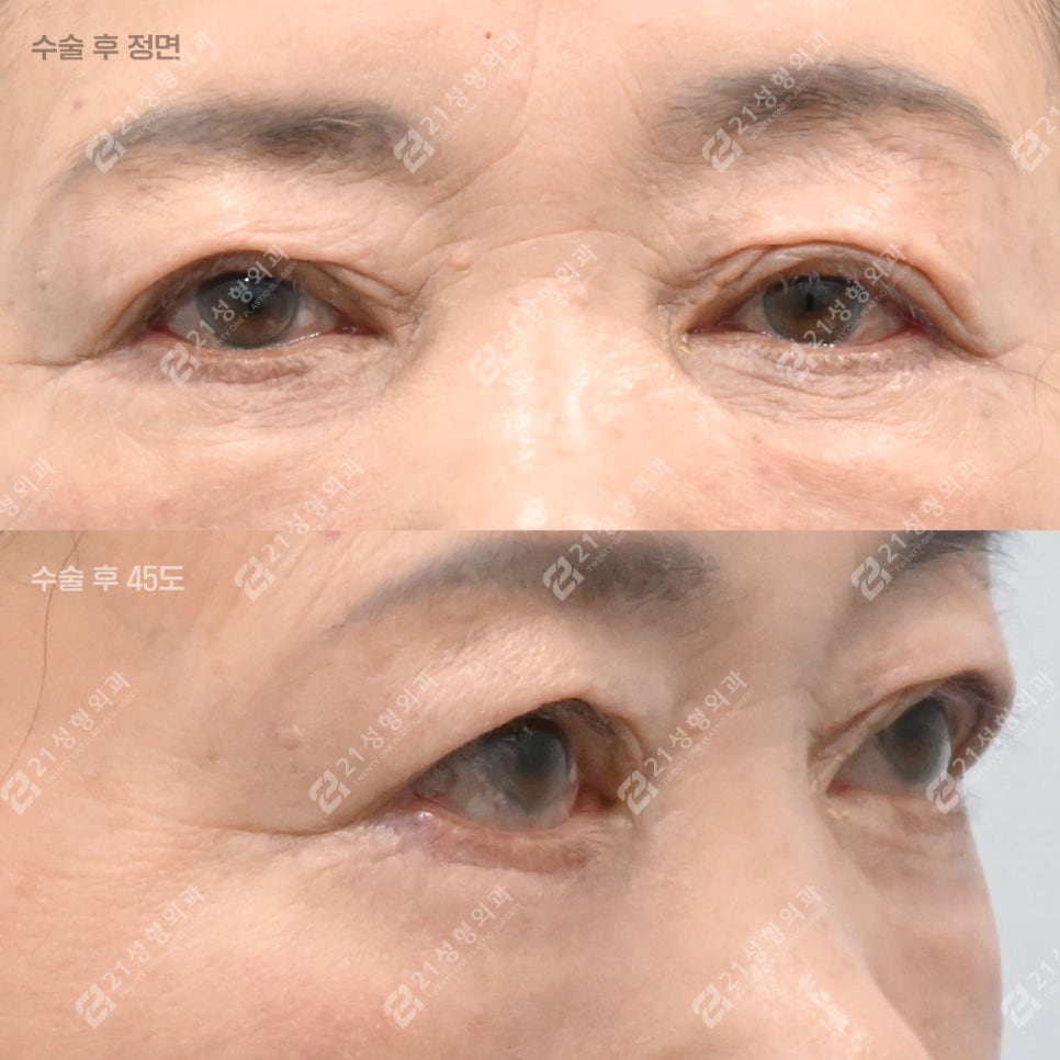 이거 모르면 하안검 수술 절대 하지 마세요! 관련 이미지 3