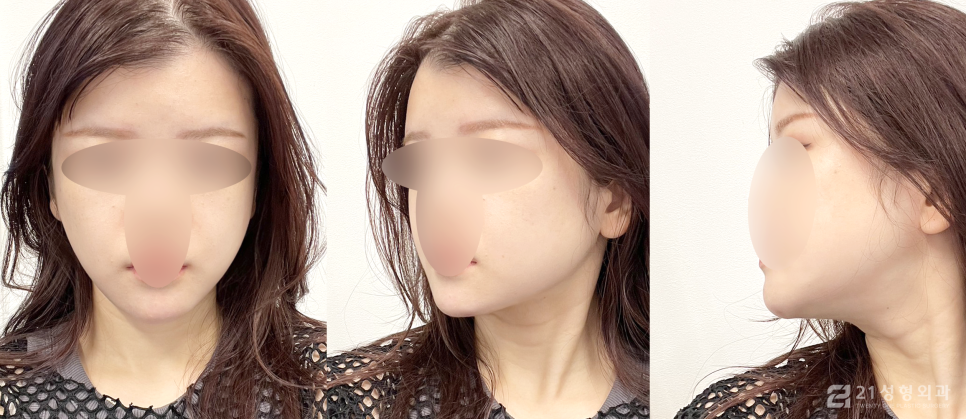 안면윤곽3종 달라지는 라인의 비결 관련 이미지 5