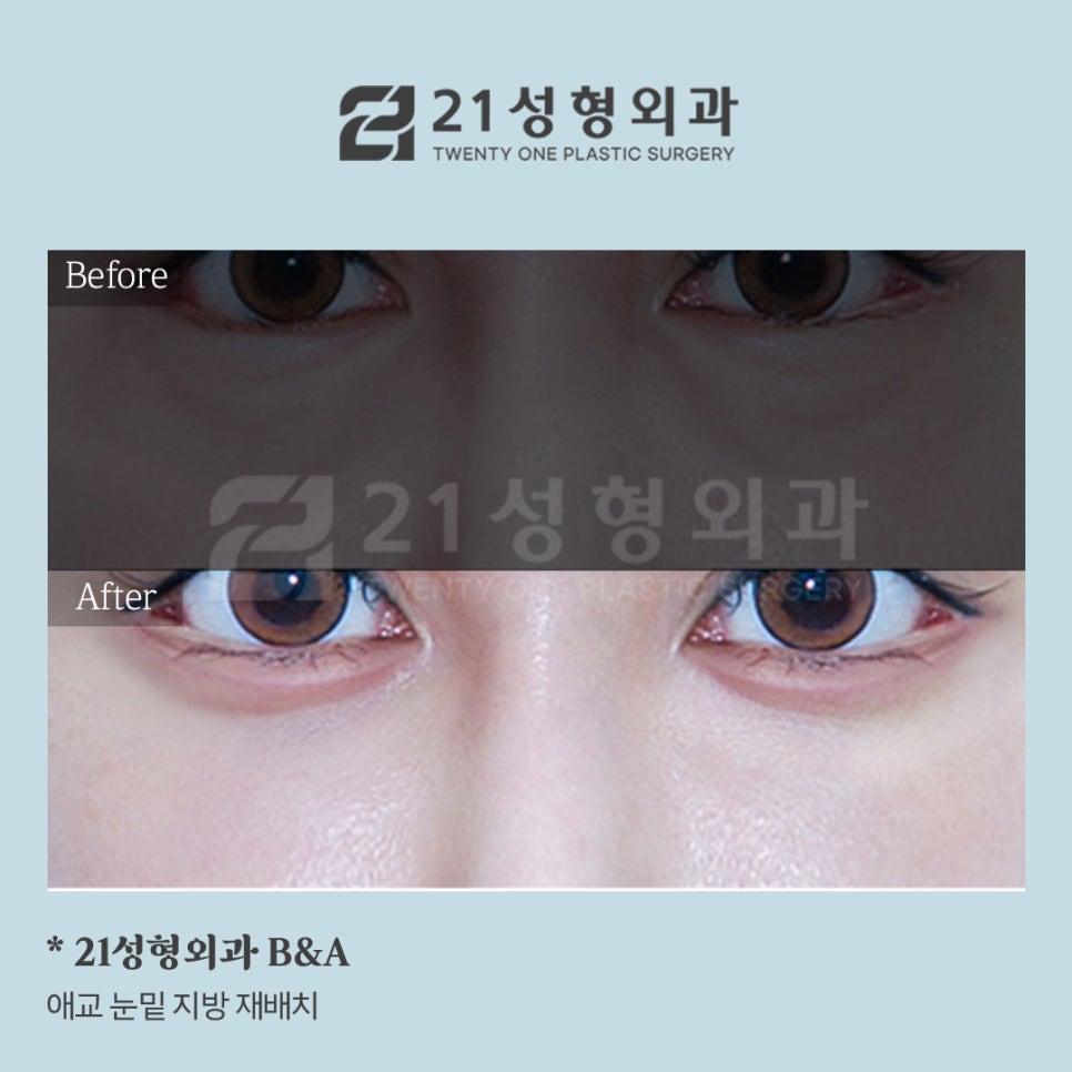 [지방재배치] 애교살 눈밑 지방 재배치는 어떤 경우 필요할까? [21성형 외과] 관련 이미지 5
