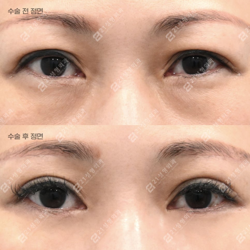 중년 눈성형, 눈썹하거상+하안검으로 자연스러운 동안 만들기! 관련 이미지 1