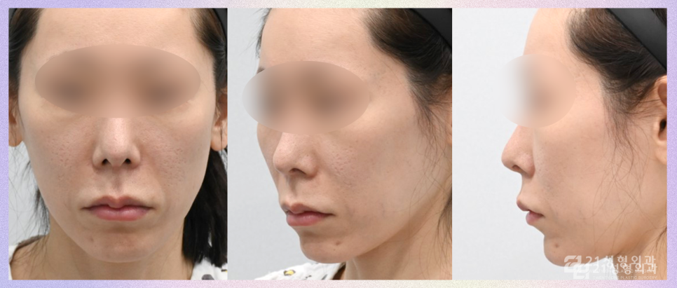 강남인중성형만으로 중안부 줄이기 관련 이미지 4