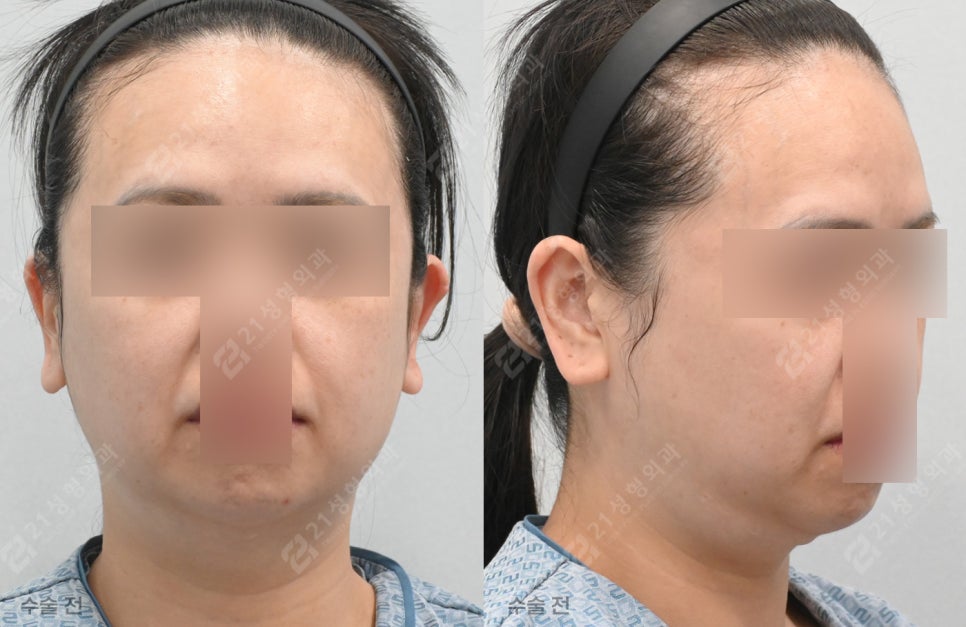 Why Does My Face Still Look the Same Even After Having Many Lifting Procedures? image 4