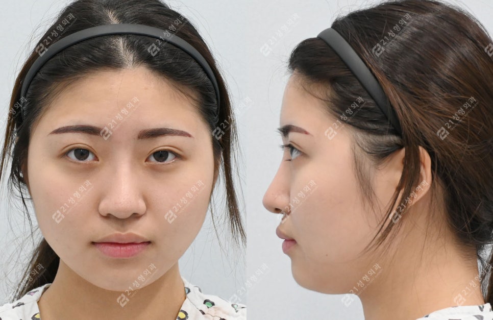 Real Review of Square Jaw Surgery: Square Jaw Surgery Is Not Over After Just Shaving the Bone image 3