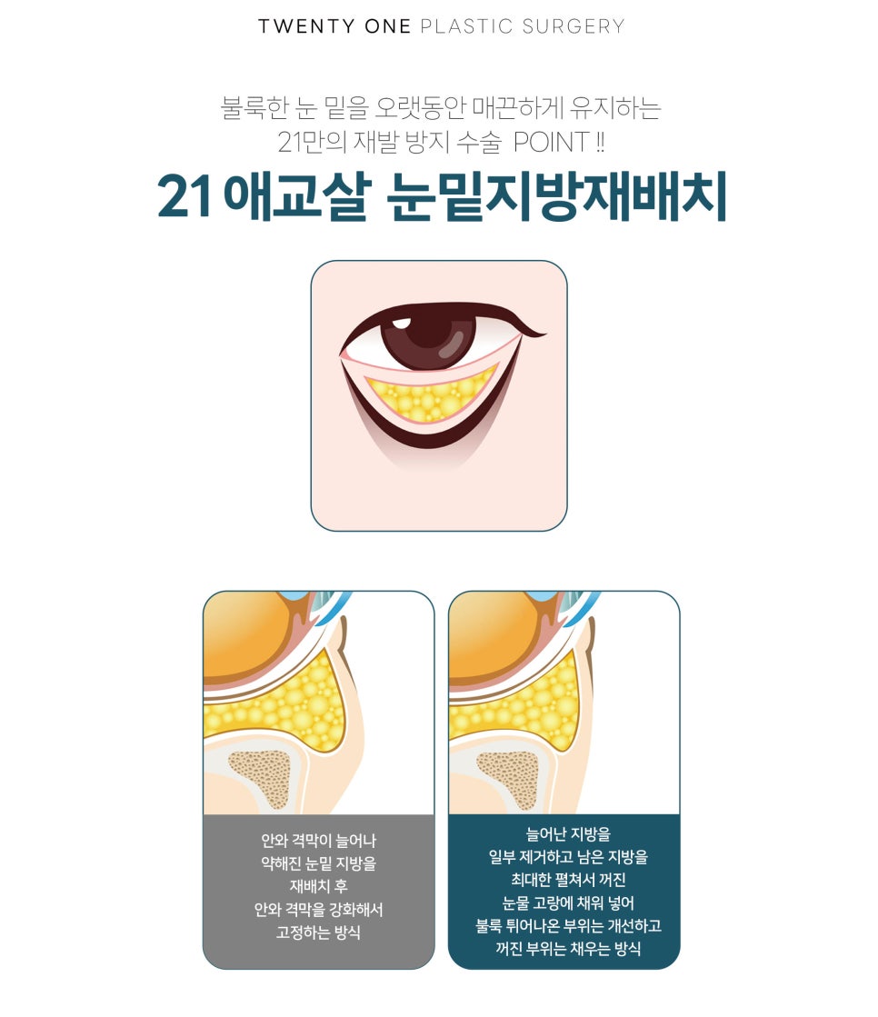 [지방재배치] 애교살 눈밑 지방 재배치는 어떤 경우 필요할까? [21성형 외과] 관련 이미지 3
