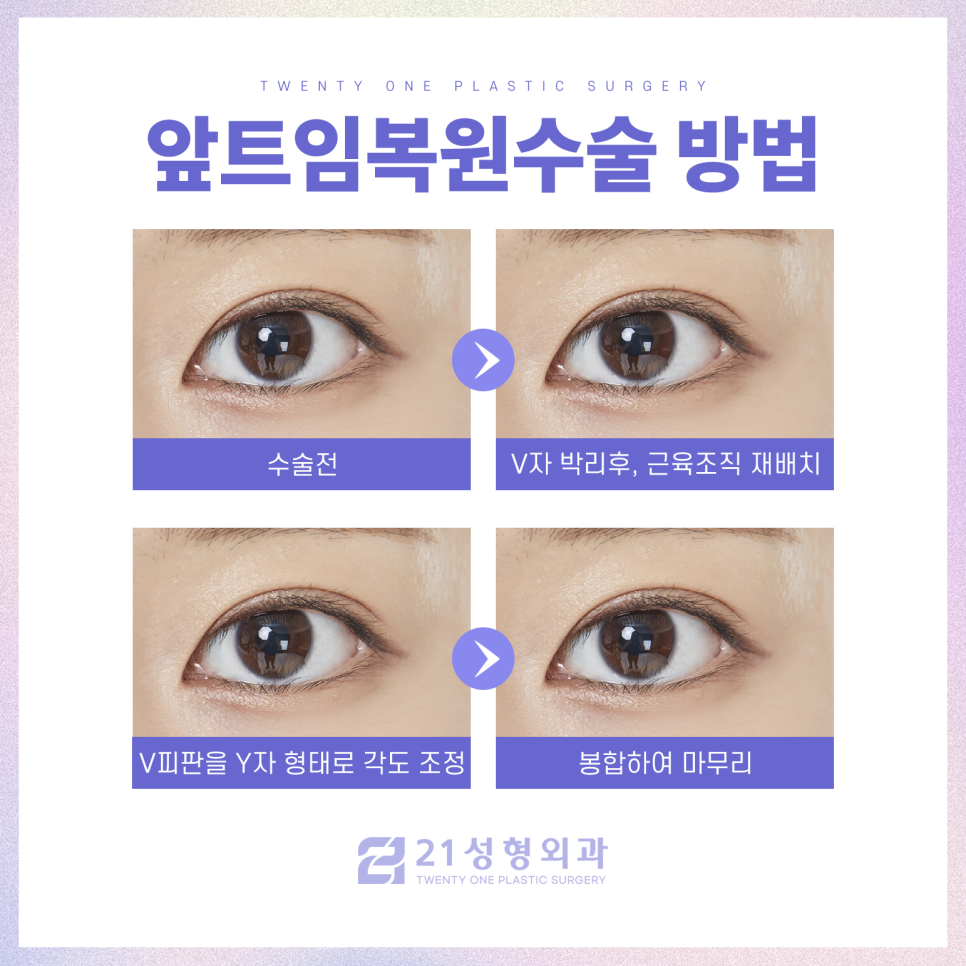 앞트임복원수술 자연스러운 눈매로 재탄생 관련 이미지 4