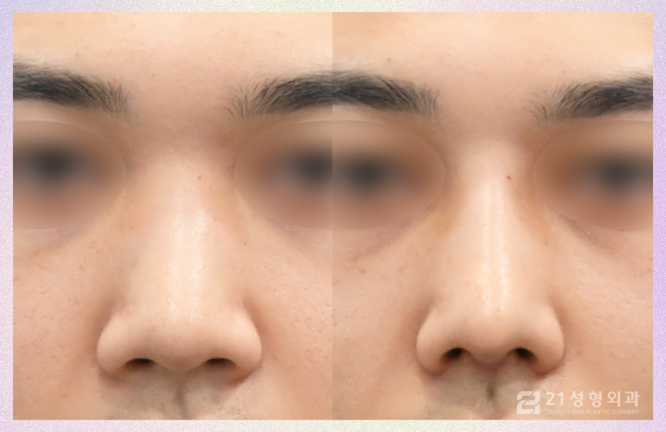 강남남자코수술 잘하는 병원의 기준 관련 이미지 1