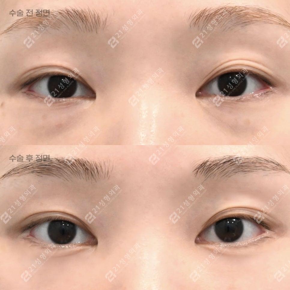Dark Circles, Caused by Lack of Sleep? Lower Eyelid Fat May Be the Reason! image 1