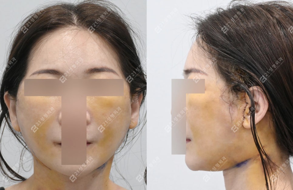 Natural Ear Lines Without Knife-Edge Earlobes: Facelift + Neck Lift Surgery Review image 4