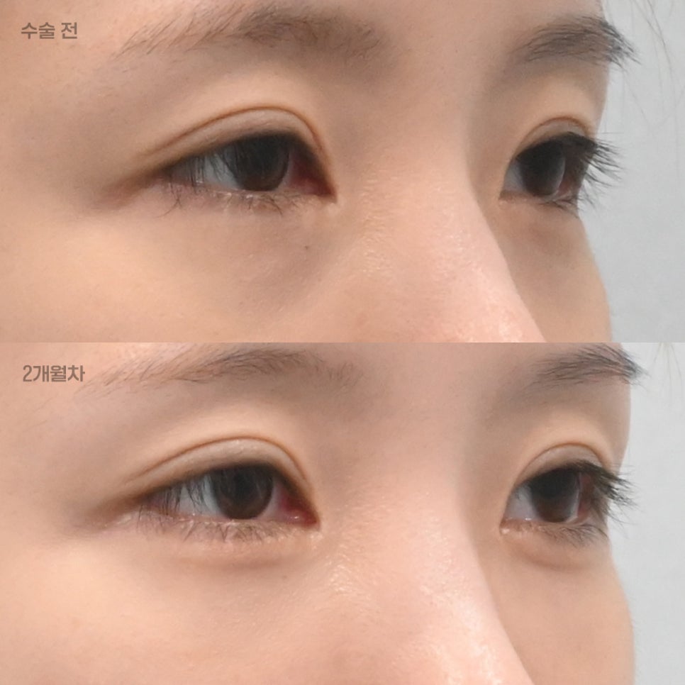 눈밑지방재배치 후 피&middot;눈물&middot;멍&middot;부기 과연 괜찮은 걸까? 관련 이미지 2