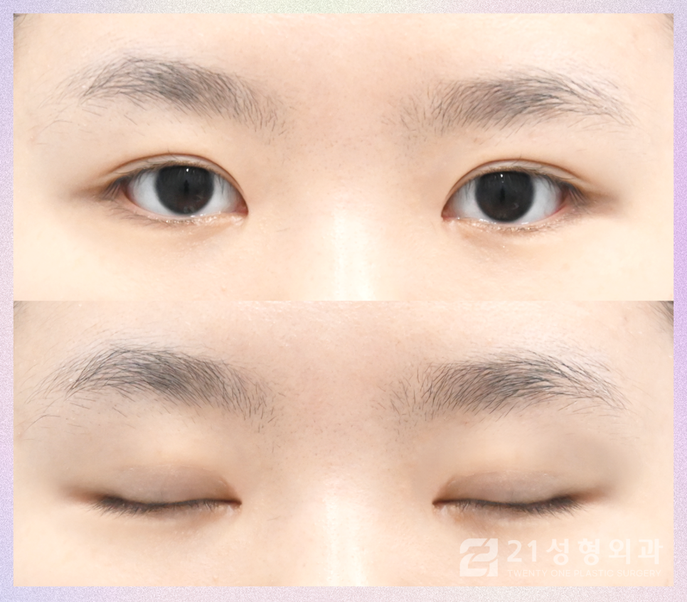강남쌍꺼풀수술잘하는곳 찾아보는 포인트 관련 이미지 6