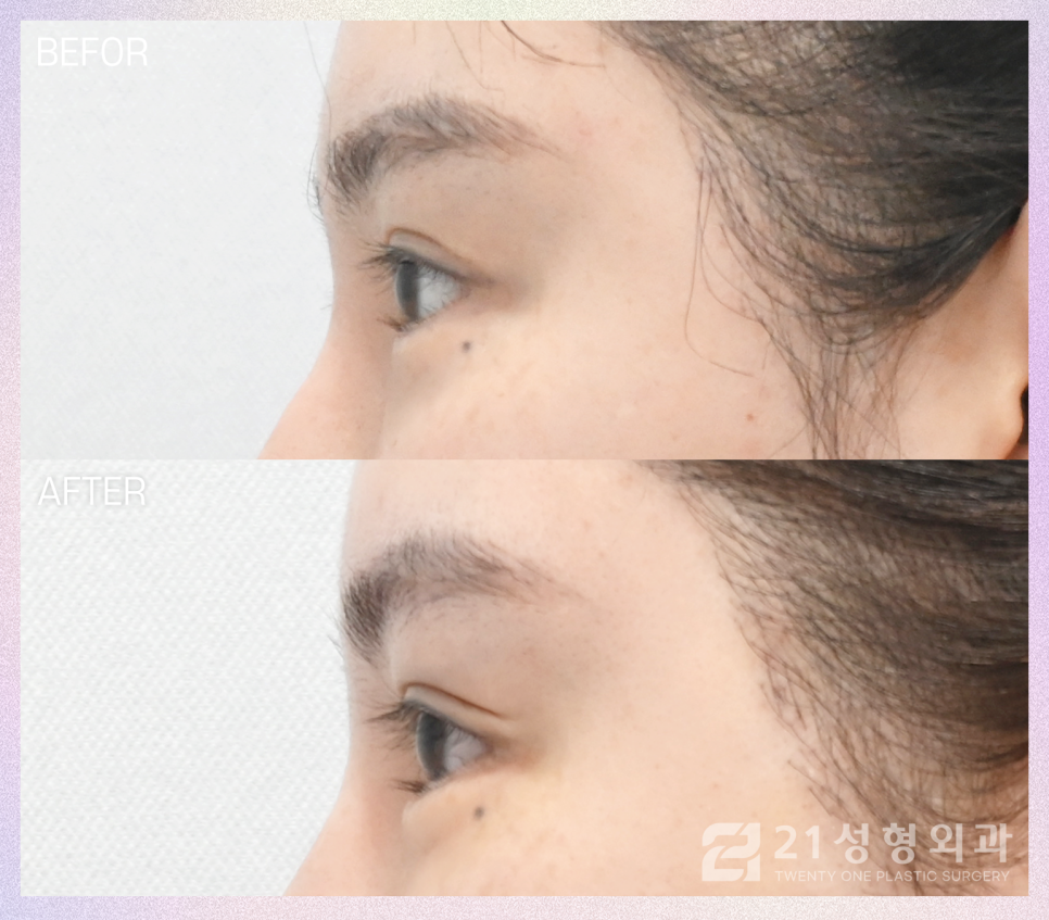 강남눈밑지방재배치잘하는곳 처지고 밋밋한 눈매 관리 관련 이미지 6