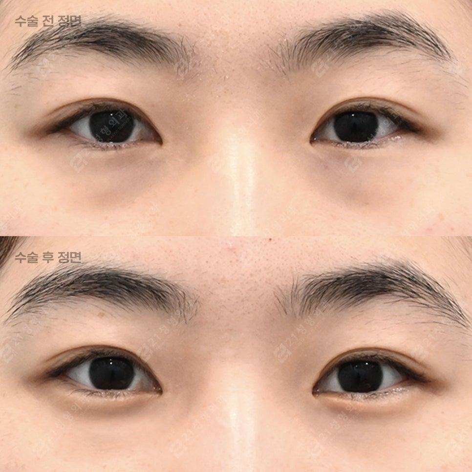 눈밑지애교 vs 하안검애교, 내게 맞는 눈밑수술은? 관련 이미지 1