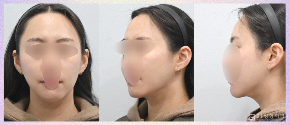 이중턱지방제거 콤플렉스라면 관련 이미지 6