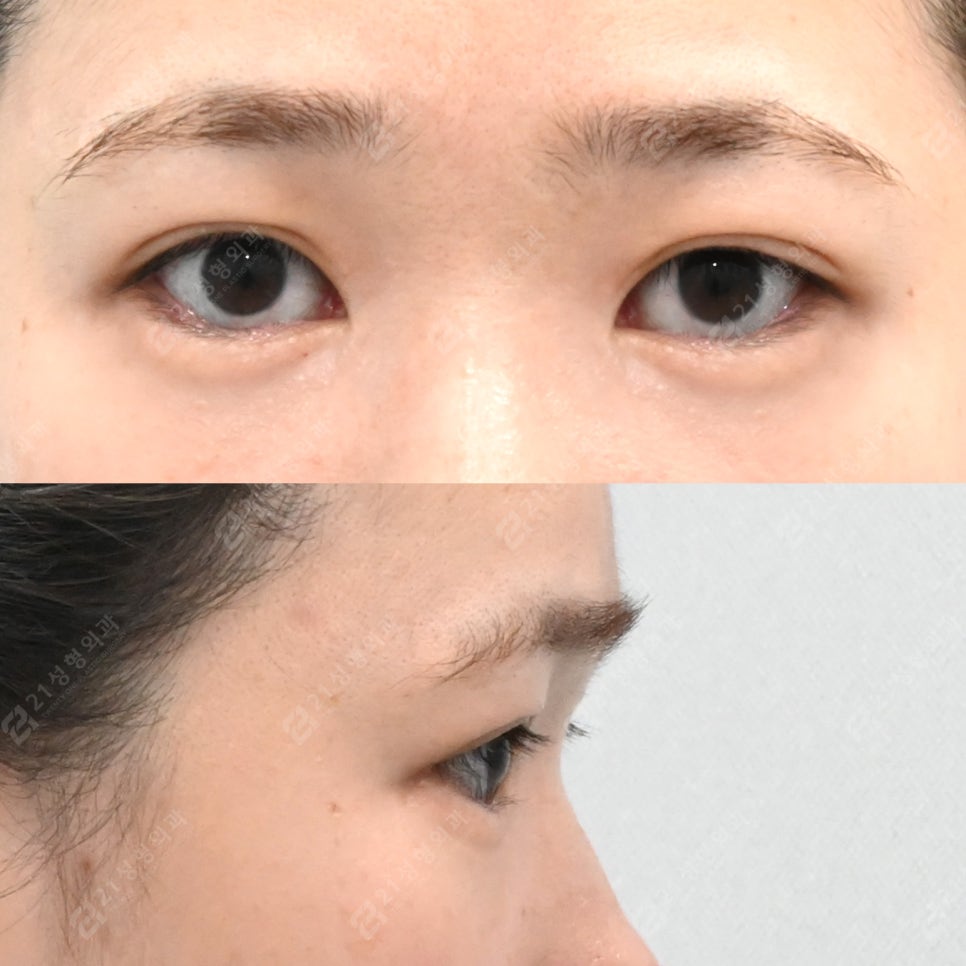 Under-eye fat that filler couldn’t hide: a 3-month and 4-month review after under-eye surgery image 4