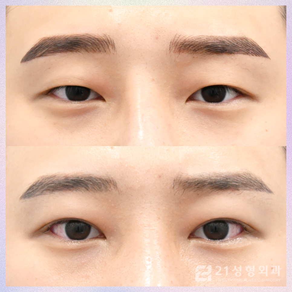 남자눈성형외과 결정에서 가장 중요한 핵심은 관련 이미지 1