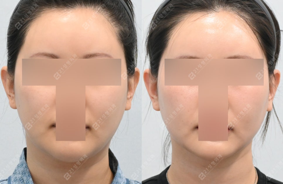 이중턱 지방흡입 받았는데 왜 그대로일까요? 관련 이미지 1