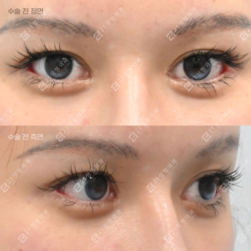 The Reason Lower Eyelid Fat Repositioning Is Needed, Explained Through the Structure Under the Eyes image 3