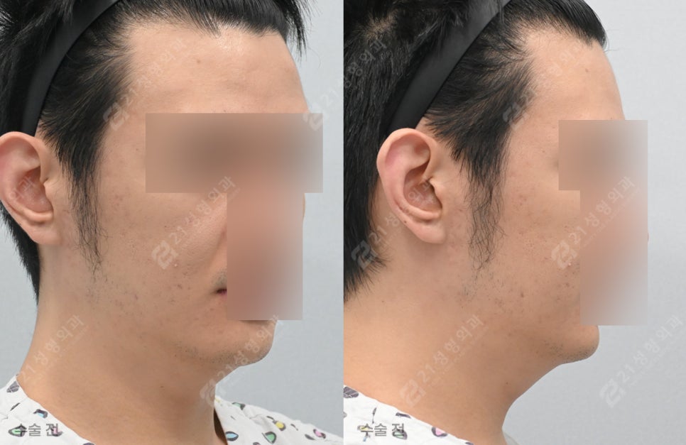 Have You Regretted Having Only Double-Chin Liposuction? Why Muscle Tightening May Be Needed for Successful Double-Chin Surgery image 6