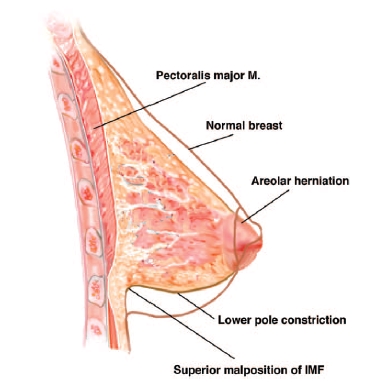 관상형 유방 (Tubular breast) 관련 이미지 6