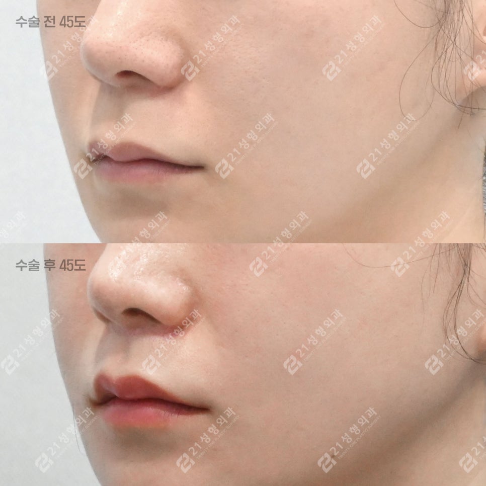 Lip Lift Review | What Matters More Than Length Is Facial Proportion! image 8
