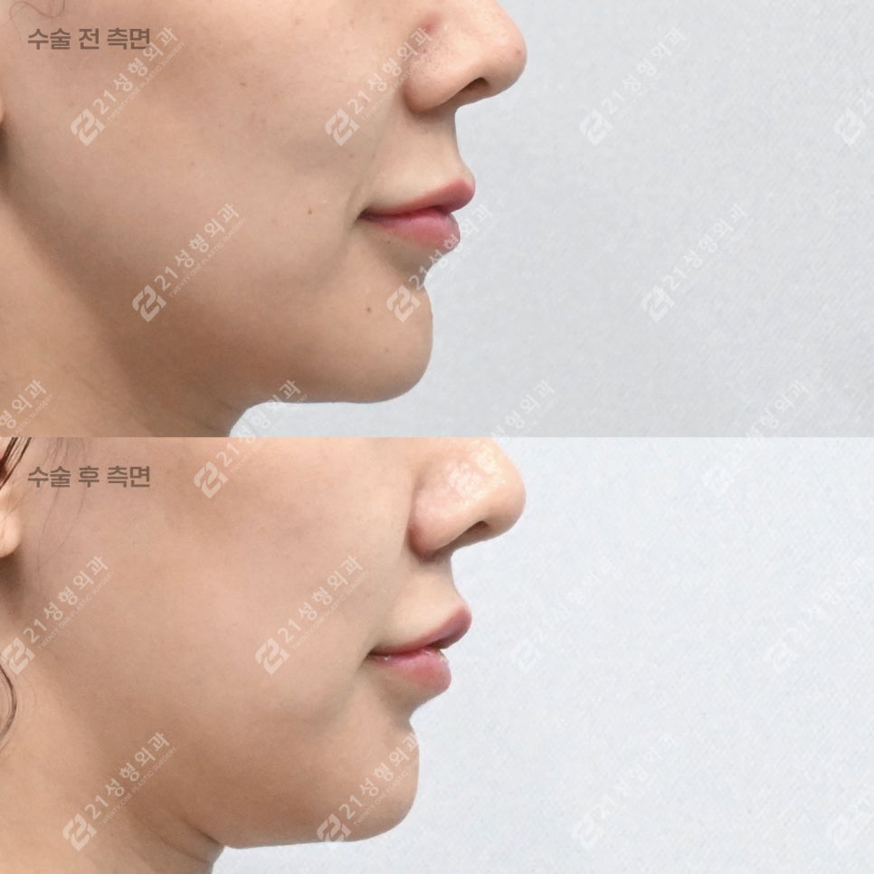 인중축소 후 얼굴이 더 입체적으로 보인 이유, 인중오목술 때문이었습니다 관련 이미지 6