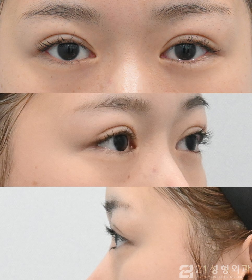 재발하기 않는 밑트임 방법 21성형외과 관련 이미지 4