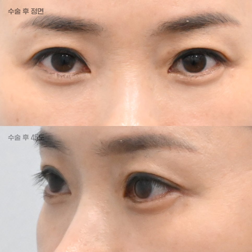 상담할 때 눈밑 피부를 먼저 확인하는 이유 관련 이미지 5