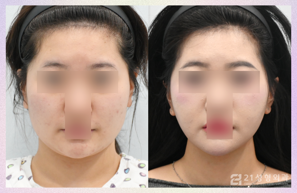 투턱지방흡입 갸름한 턱라인을 위해 관련 이미지 1