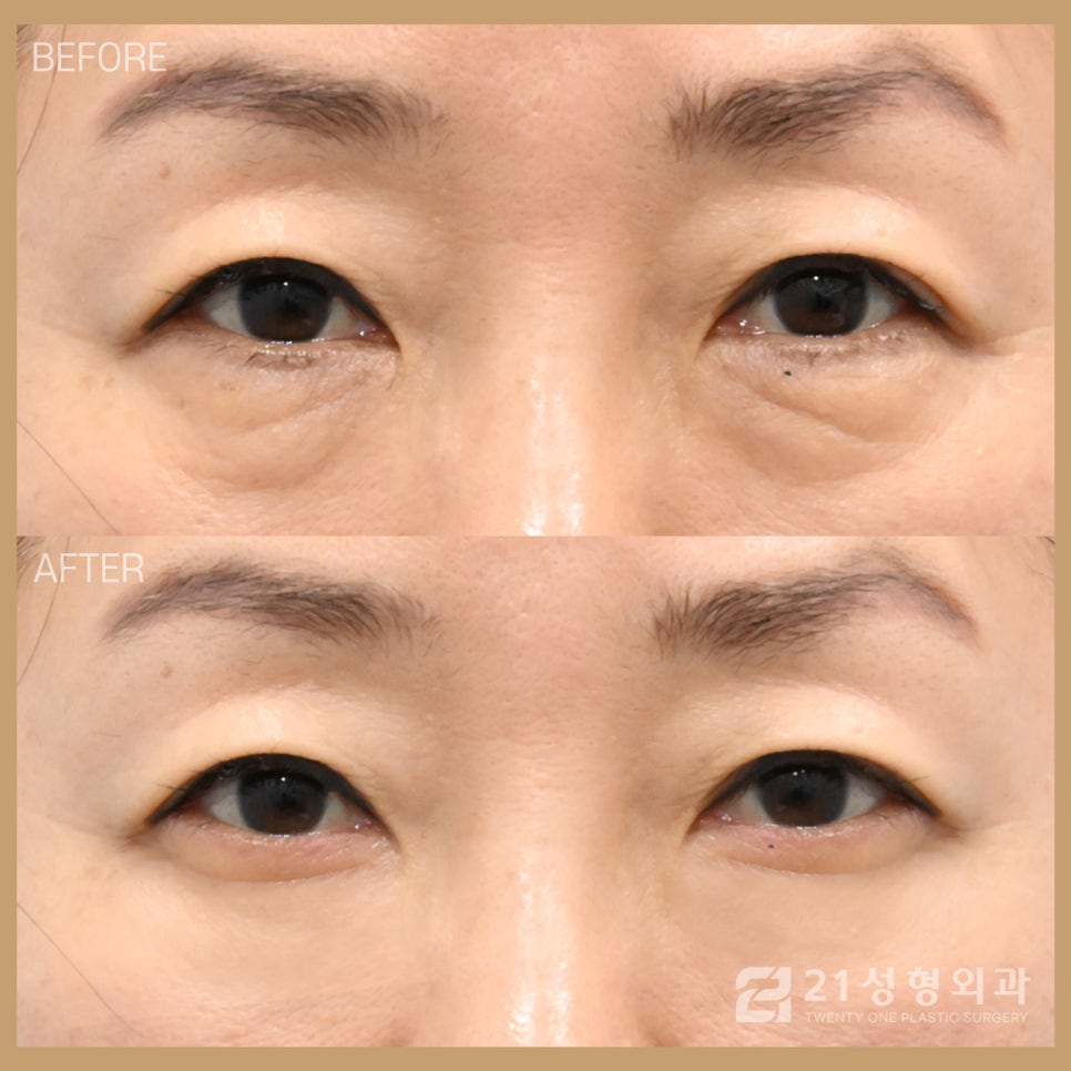 중년하안검 흉터 미리 방지 가능합니다 관련 이미지 1