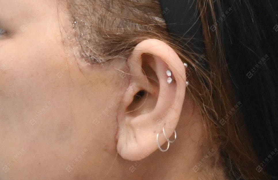 Facelift Surgery Without a Pulled Earlobe: A Real Patient Review image 2