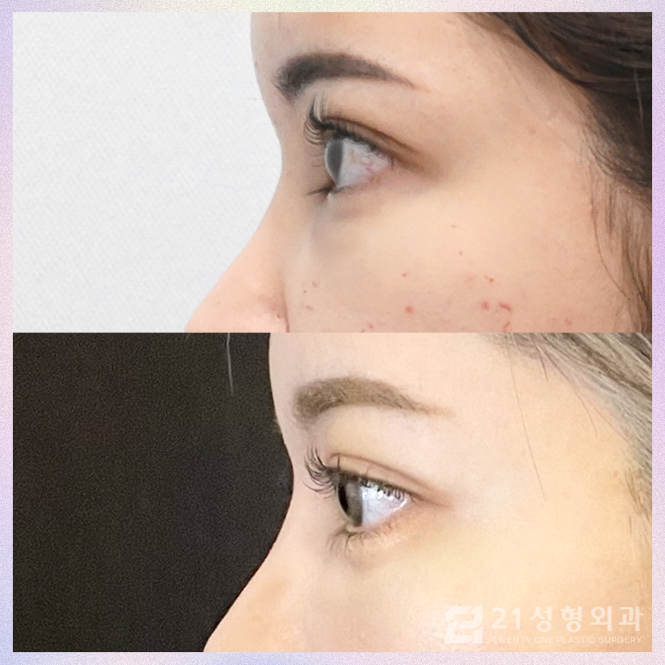 눈밑지방재배치병원 선택 시 고려해야 하는 것 관련 이미지 4