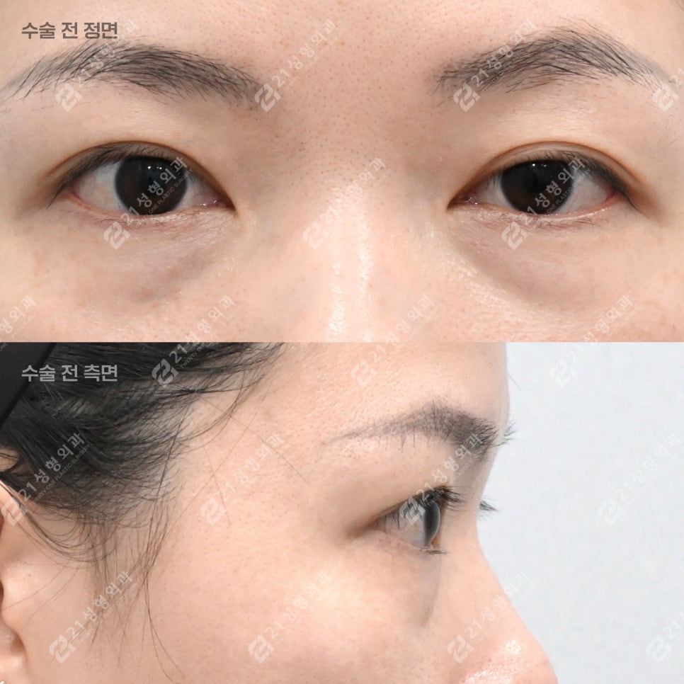 눈밑지방재배치, 30대인데 피곤해 보이는 이유 관련 이미지 1
