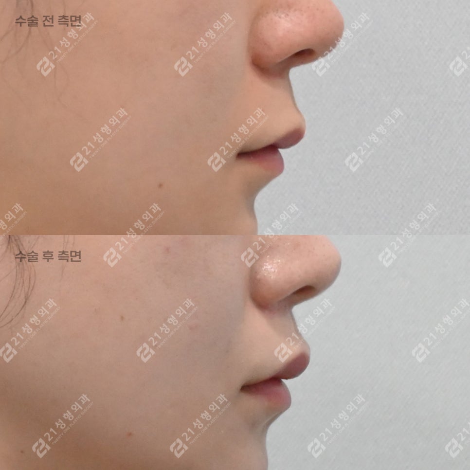 What to Check If Your Philtrum Looks Long image 2