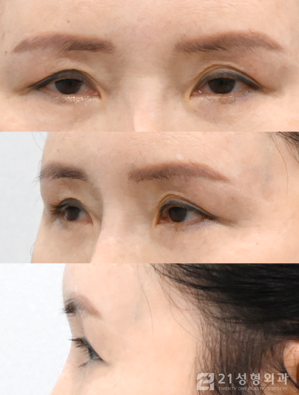 40대쌍수, 근본적인 원인부터 해결하자 관련 이미지 4