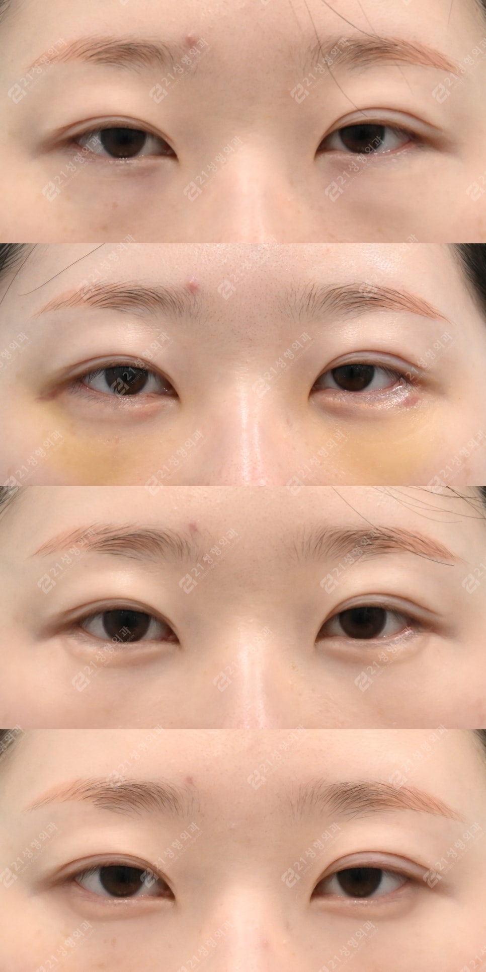Recovery Period Before and After Lower Eyelid Fat Repositioning image 6