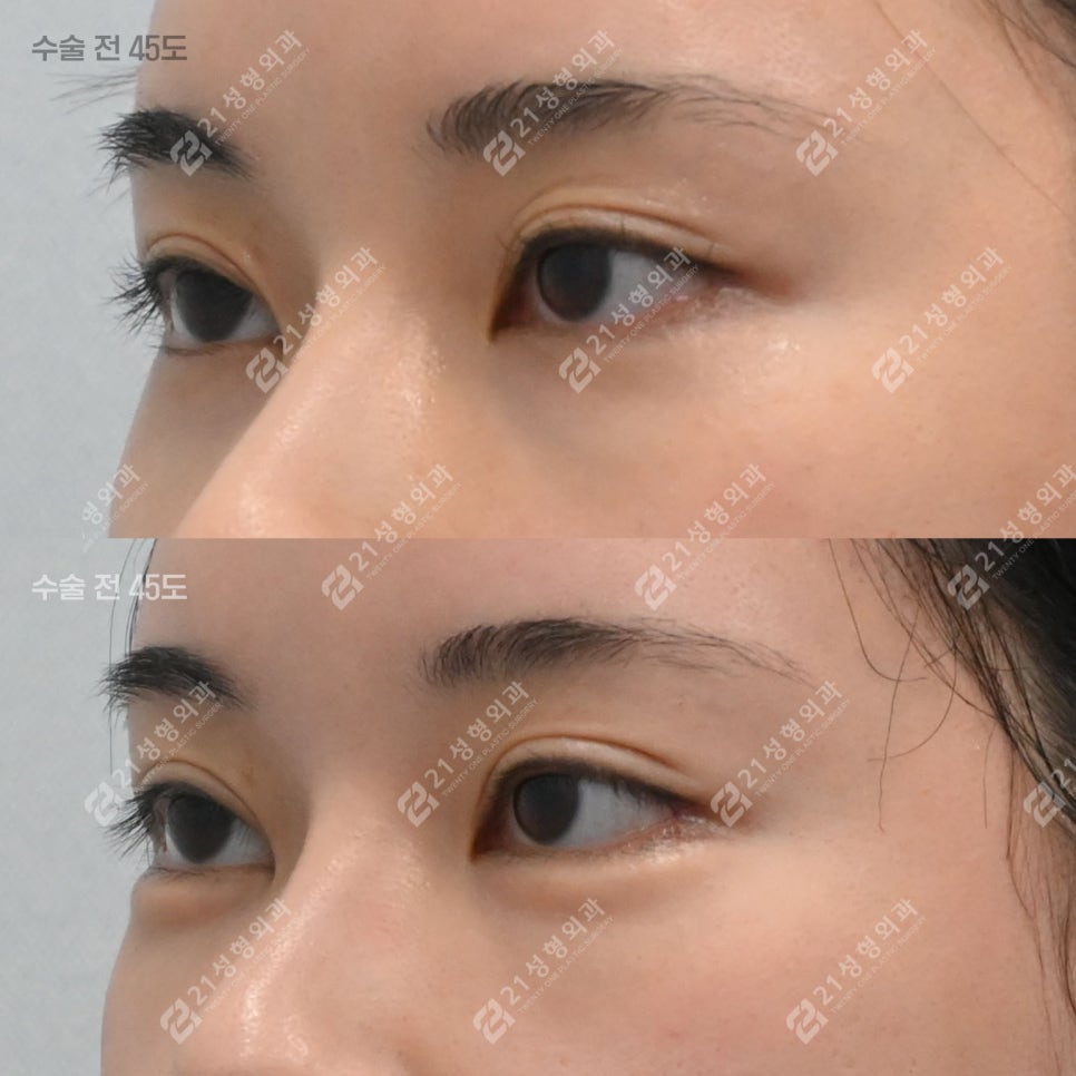 Key Points That Change Your Impression: Under-Eye Fat Repositioning and Nano-Pet Fat Grafting image 7