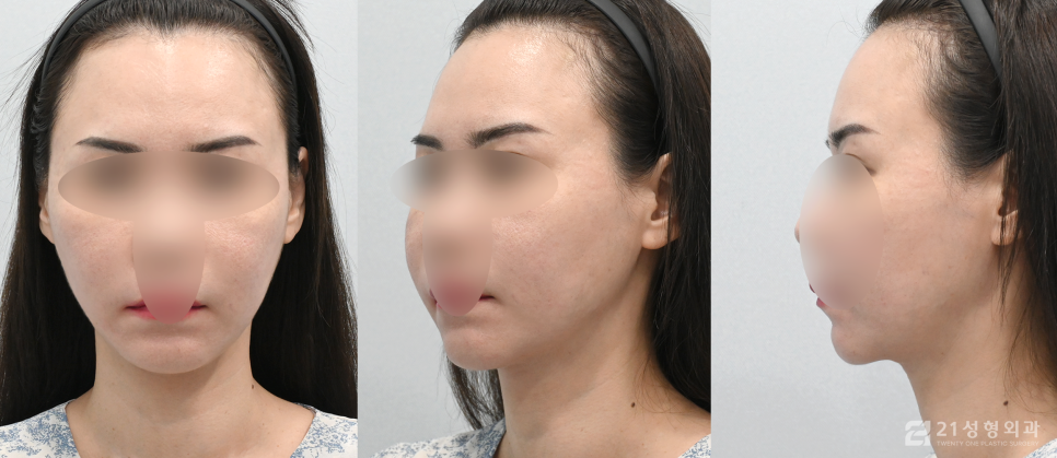 턱밑침샘개선방법으로 이중턱 얼굴라인을 갸름하게 관련 이미지 5