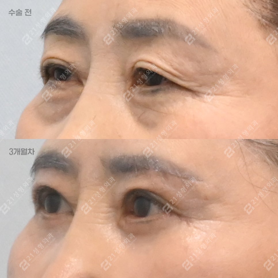 If You Keep Tensing Your Forehead, Consider Eyelid Drooping image 2