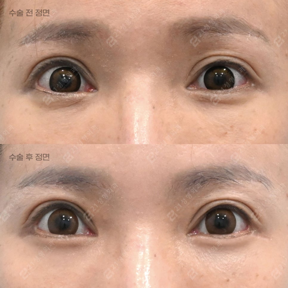 눈밑지애교 vs 하안검애교, 내게 맞는 눈밑수술은? 관련 이미지 5
