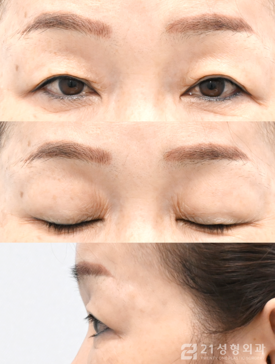 강남눈수술잘하는곳 찾아보고 있다면 관련 이미지 4