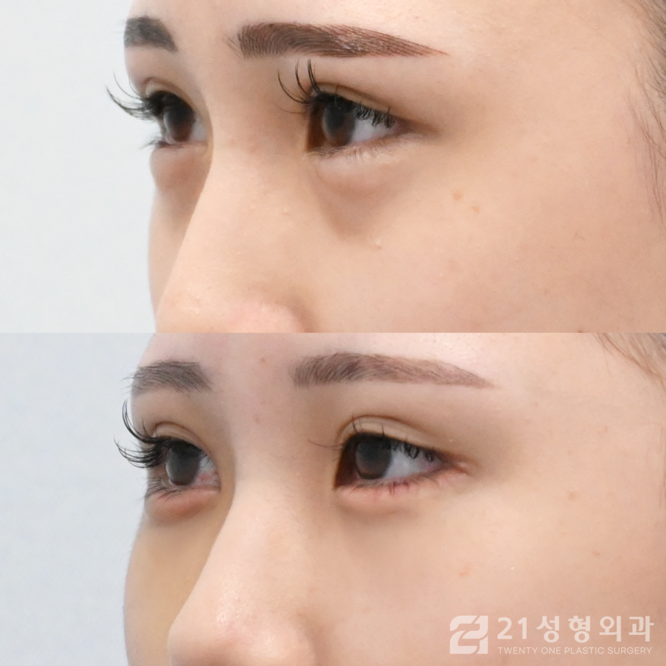 눈밑지방없애는방법 확실한 효과를 얻고 싶다면 관련 이미지 2