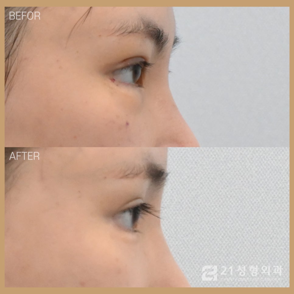 애교살수술은 나노펫 지방이식으로 해결 관련 이미지 3