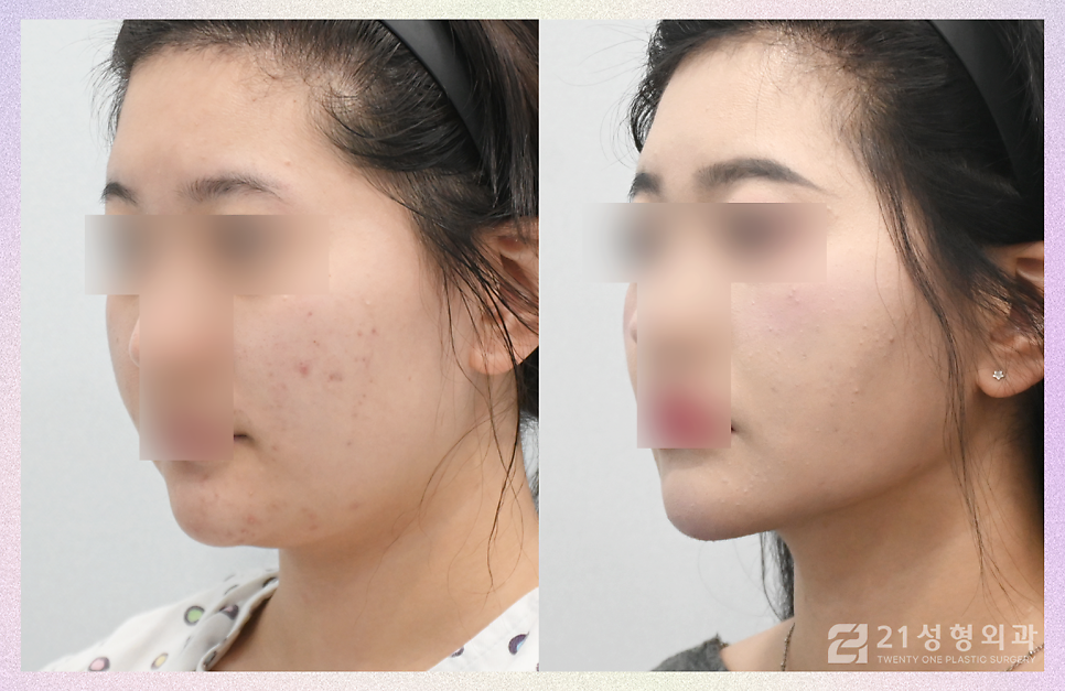 투턱지방흡입 갸름한 턱라인을 위해 관련 이미지 2