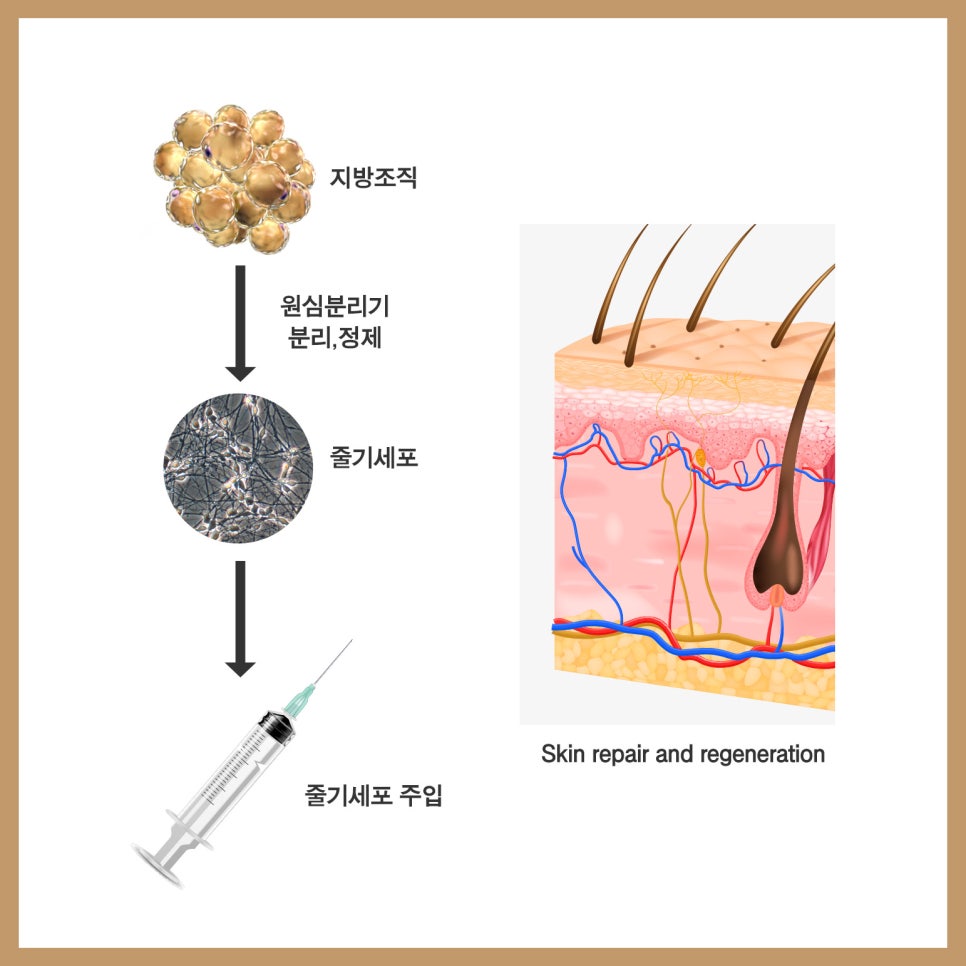 줄기세포애교지방이식으로 카리나 애굣살 만들기 관련 이미지 7
