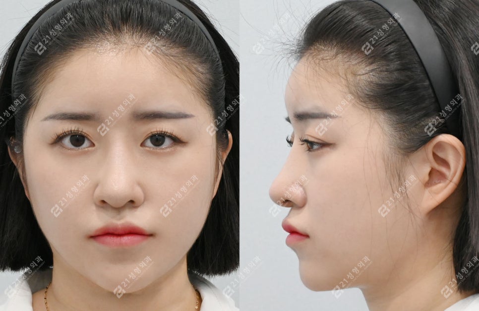 코성형 후 인상이 달라진 이유, 얼굴 중심의 차이 관련 이미지 4